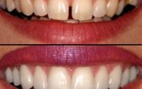 ecd970ad-f526-4182-a11e-4aae7035aa4e Cosmetic Smile Designing